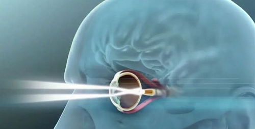 اختراع طبي ثوري يعيد الأمل للمكفوفين شريحة ذكية تُمكّن المرضى من الرؤية مجددًا
