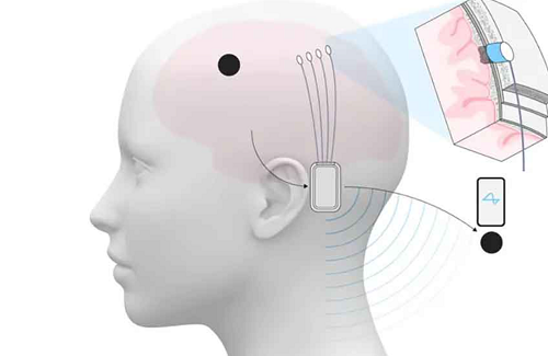 نيورالينك تتجه إلى الإنتاج الضخم لشرائح الدماغ والعمليات الآلية الكاملة بحلول 2026